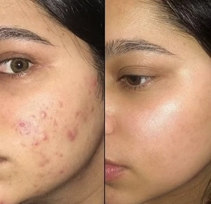 Types of acne scars - ice pick, boxcar and rolling scars explained